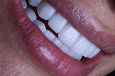 img-Porcelana-2