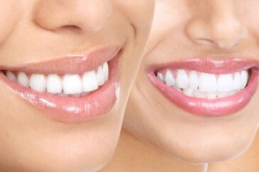 ortodoncia-diseno-de-sonrisa